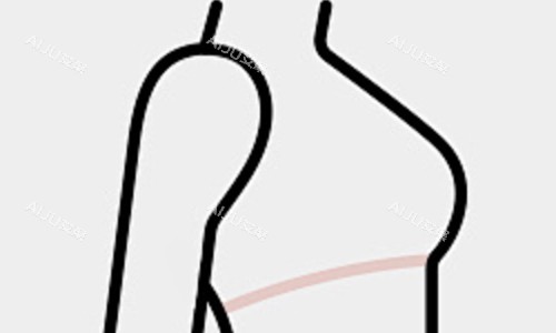 隆胸后展示 隆胸后展示