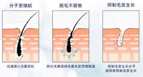 脱毛后毛囊的变化 脱毛后毛囊的变化