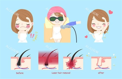 激光脱毛过程 激光脱毛过程