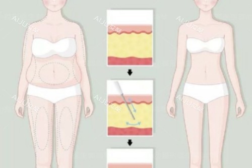 吸脂卡通前后对比一览图