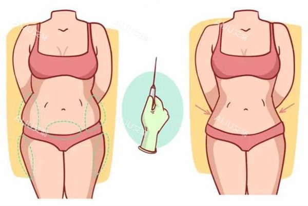 吸脂填充术 吸脂填充术