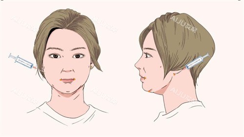 面部吸脂手术针管注射点位动画图 面部吸脂手术针管注射点位动画图