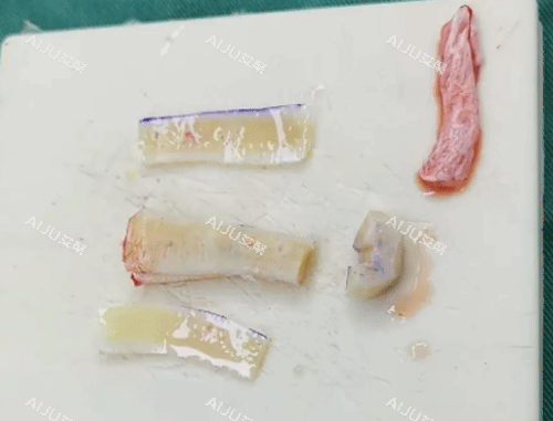 肋骨隆鼻材料 肋骨隆鼻材料