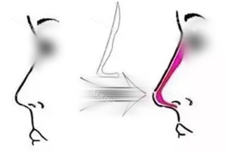 隆鼻手术填充前后对比图 隆鼻手术填充前后对比图