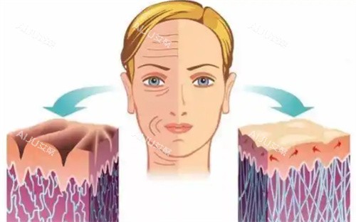 微拉美提升手术前后 微拉美提升手术前后