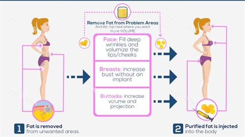 自体脂肪隆胸详情 自体脂肪隆胸详情