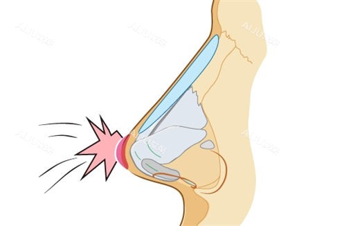 隆鼻假体鼻背动画展示图 隆鼻假体鼻背动画展示图