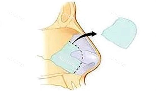 鼻中隔软骨隆鼻移除位置展示图 鼻中隔软骨隆鼻移除位置展示图