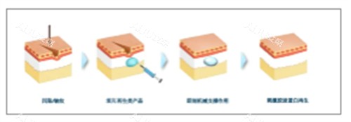 童颜针注射前后对比图解