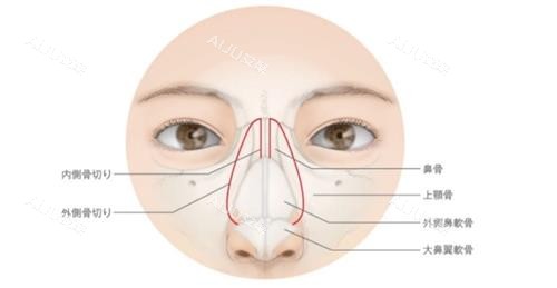 鼻骨内推的部位 鼻骨内推的部位