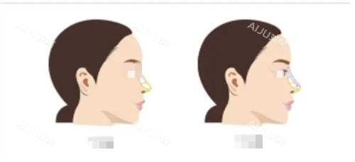 隆鼻前后对比示意图 隆鼻前后对比示意图