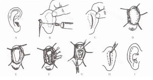 耳朵矫正手术 耳朵矫正手术