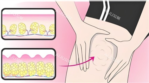 吸脂大腿部位 吸脂大腿部位