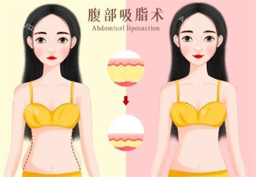 吸脂前后对比 吸脂前后对比