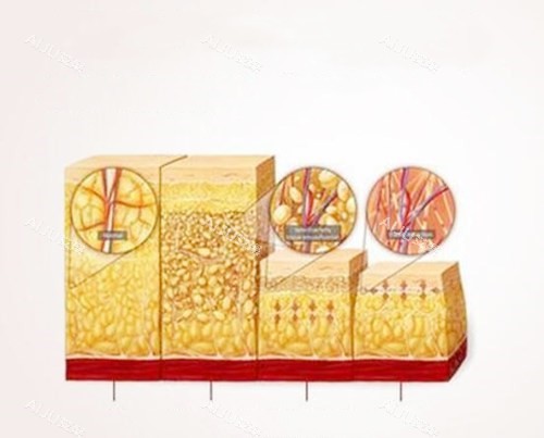 吸脂卡通图展示 吸脂卡通图展示