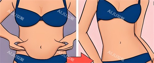 腹部吸脂术前后对比动画图 腹部吸脂术前后对比动画图