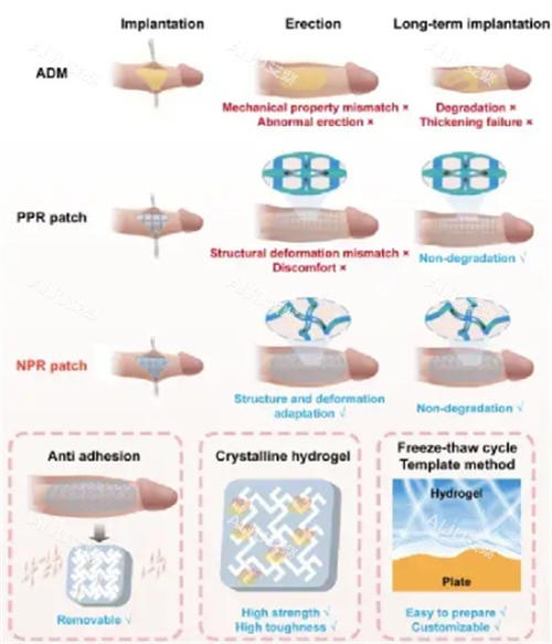 阴茎生物补片手术过程 阴茎生物补片手术过程