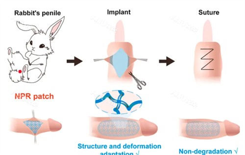 阴茎生物补片演示过程 阴茎生物补片演示过程
