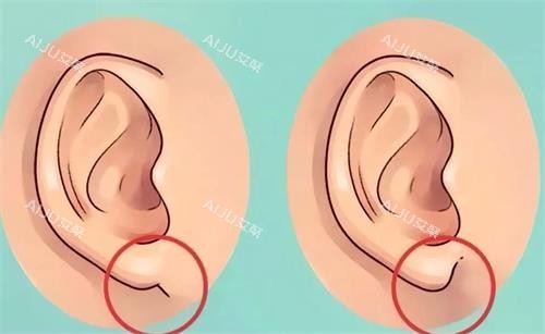 耳垂整形 耳垂整形