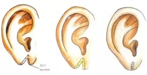 耳垂裂开修复的过程 耳垂裂开修复的过程