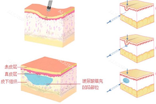 玻尿酸填充皮下组织示意图 玻尿酸填充皮下组织示意图