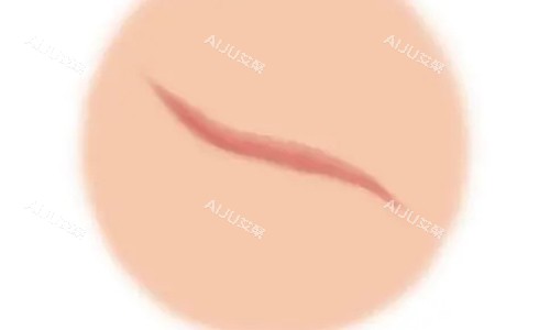 疤痕增生的不同动画展示图 疤痕增生的不同动画展示图