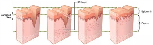 凹陷疤痕填充前后对比 凹陷疤痕填充前后对比
