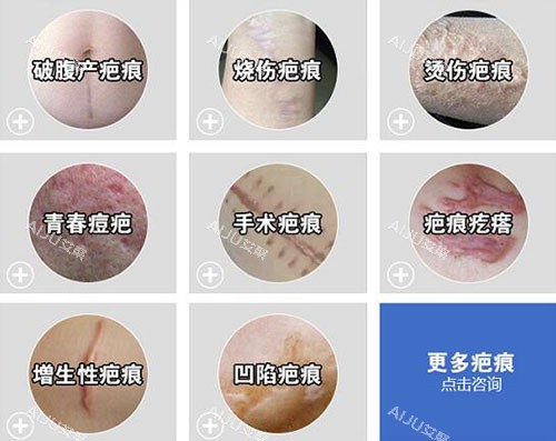 哪些疤痕需要祛除改善 哪些疤痕需要祛除改善