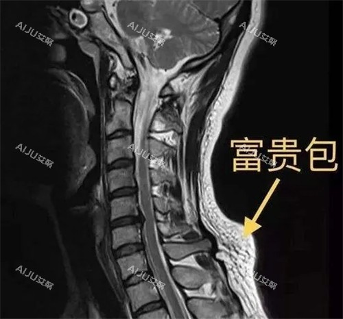 CT下的富贵包图示 CT下的富贵包图示