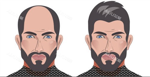 植发前后对比图一览 植发前后对比图一览