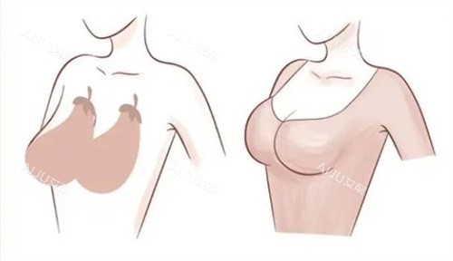 胸部下垂 胸部下垂