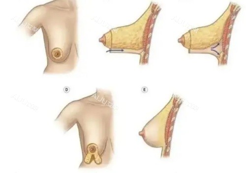 胸部下垂手术示意图 胸部下垂手术示意图