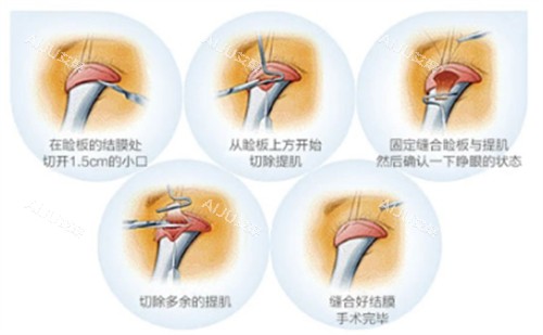 上睑下垂手术过程图 上睑下垂手术过程图