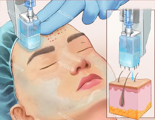 面部水光注射照片 面部水光注射照片