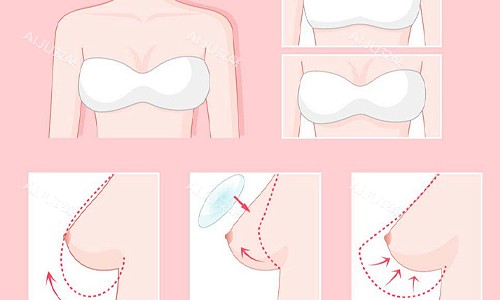 隆胸的流程展示 隆胸的流程展示