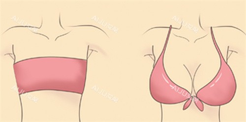 大胸缩小 大胸缩小