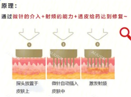 黄金微针原理分析