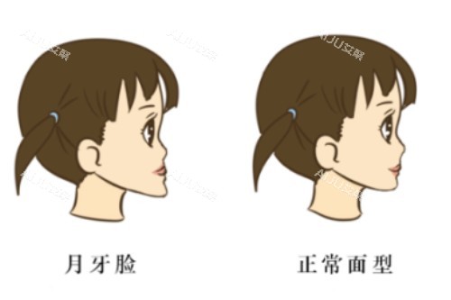 月牙脸和正常脸型前后对比图 月牙脸和正常脸型前后对比图