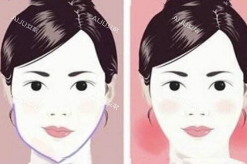 脸型不对称矫正前后对比图 脸型不对称矫正前后对比图