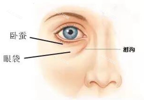 眼下卧蚕泪沟及眼袋对比示意图 眼下卧蚕泪沟及眼袋对比示意图