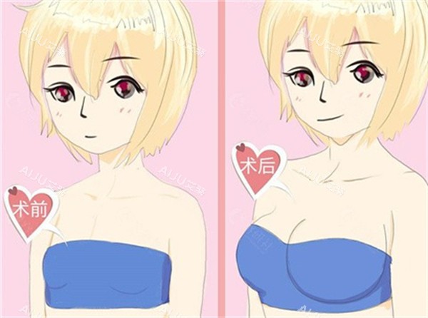 隆胸前后对比图 隆胸前后对比图