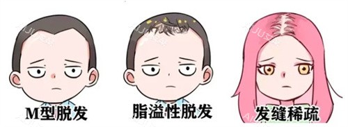 脱发种类 脱发种类