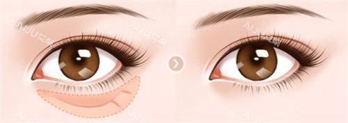 眼袋对比图 眼袋对比图