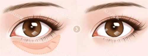 去眼袋手术前后 去眼袋手术前后