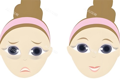 中年祛眼袋前后对比 中年祛眼袋前后对比