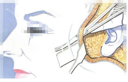 拉皮手术手术剖面图