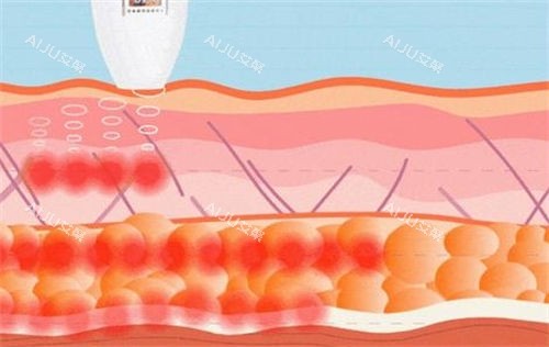 超声炮仪器作用在皮肤侧剖图