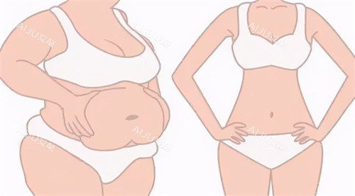 腹部吸脂前后对比过程 腹部吸脂前后对比过程