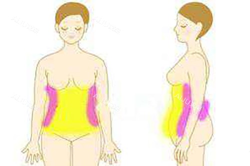 腰腹吸脂卡通示意图 腰腹吸脂卡通示意图