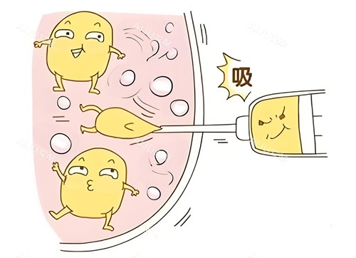吸脂 吸脂